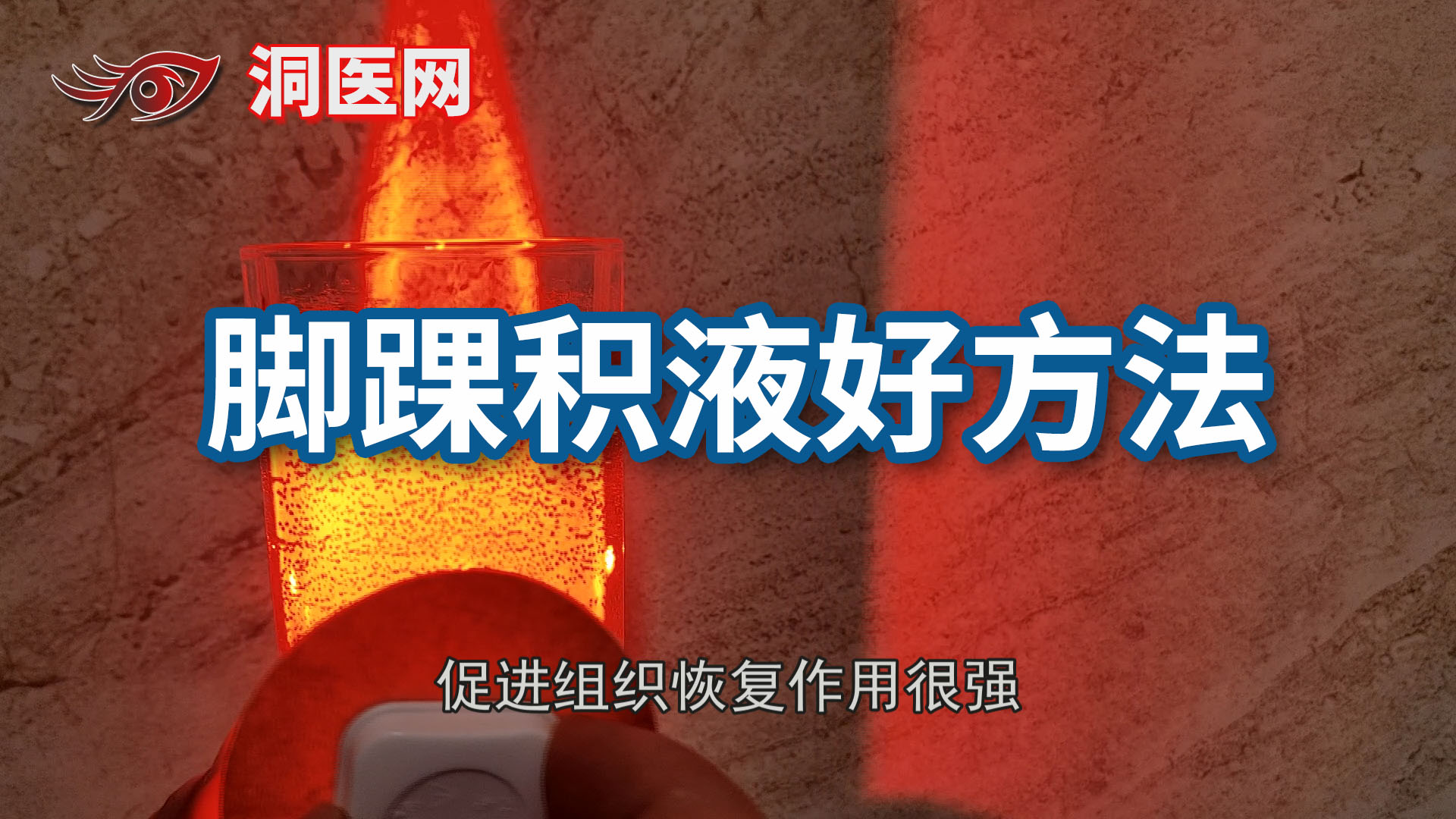 脚摔伤后怎么消肿化瘀_议美网